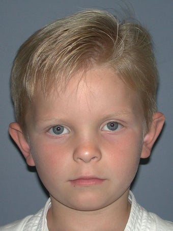 Otoplasty/Ear Surgery