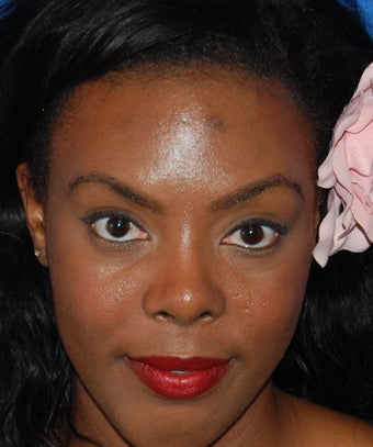 African American Rhinoplasty
