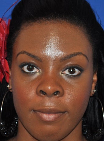 African American Rhinoplasty