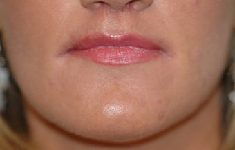 Before and After Lip Lift