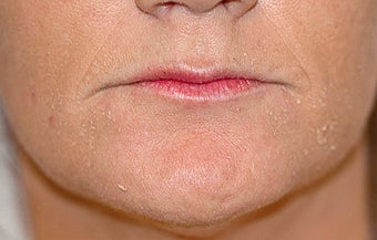 Before and After Lip Lift