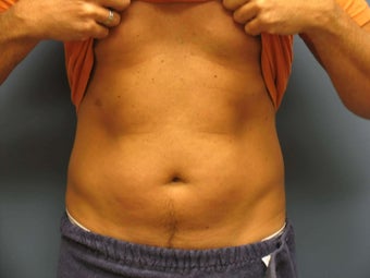 Exilis