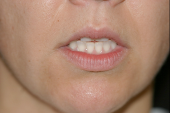 Upper Lip Lift, Fat Transfer and Lower FATMA