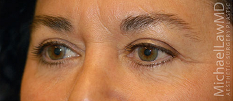 Eye Bags Treatment