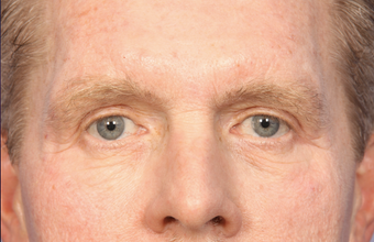 Bilateral eyelid surgery 