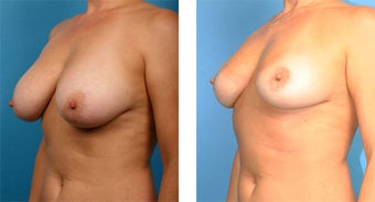 Breast Implant Removal with Internal Lift