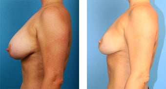 Breast Implant Removal with Internal Lift