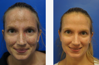 Melasma