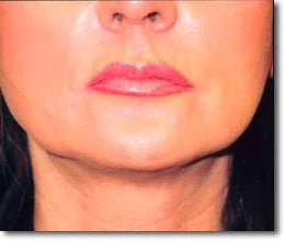 Restylane® and Perlane®