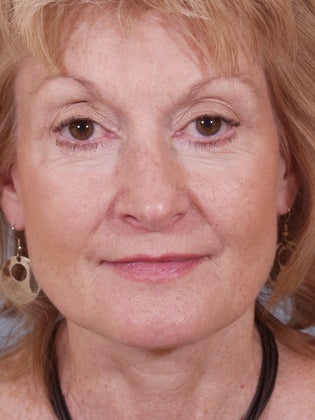 Lower Eyelid Hetter Peel