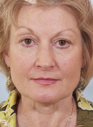 Lower Eyelid Hetter Peel
