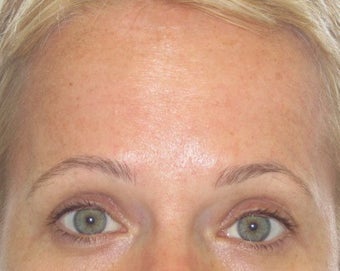 42 year old treated for forehead rhytids (wrinkles)