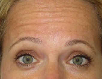 42 year old treated for forehead rhytids (wrinkles)