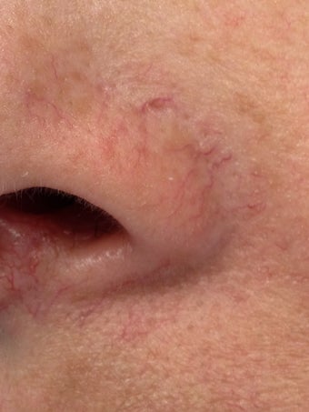 Laser treatment of nose veins and superficial spider veins