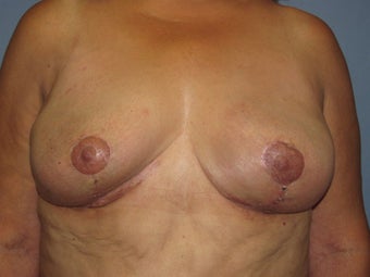 Implant Removal 