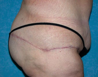 Circumferential Body Lift with Buttock Augmentation
