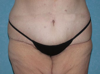 Circumferential Body Lift with Buttock Augmentation