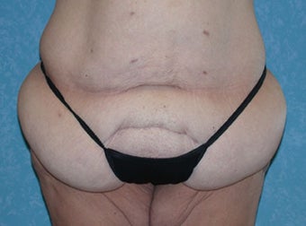 Circumferential Body Lift with Buttock Augmentation