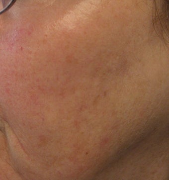 67 year old female with unwanted pigmentary changes on face