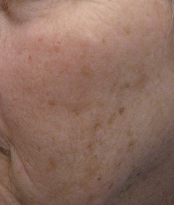 67 year old female with unwanted pigmentary changes on face