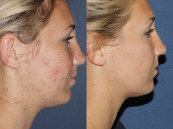Before & After Fraxel Restore