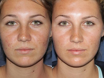 Before & After Fraxel Restore