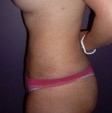Laser Liposuction