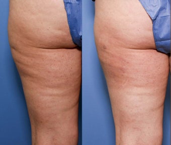 37 year old with cellulite