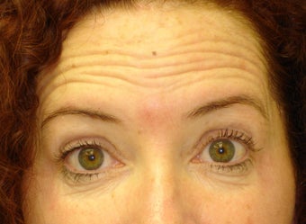 Forehead Lines