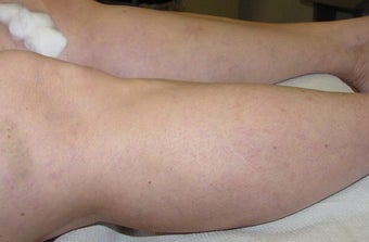 Sclerotherapy of spider veins