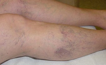 Sclerotherapy of spider veins
