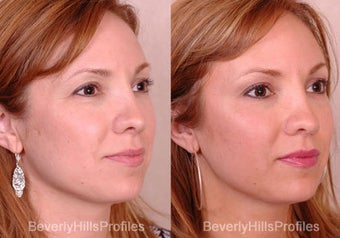 Rhinoplasty