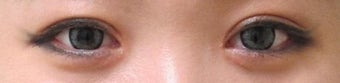 Bilateral Asian Eyelid w/ Inner Corner Surgery