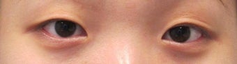 Bilateral Asian Eyelid w/ Inner Corner Surgery