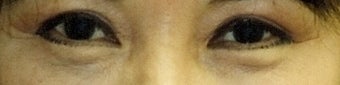 Revision Bilateral Asian Eyelid Surgery