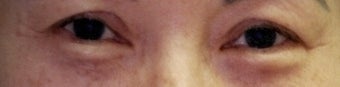 Revision Bilateral Asian Eyelid Surgery
