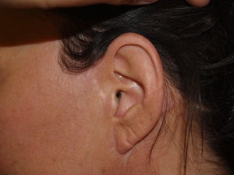 Before and after revision midfacelift 