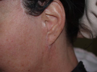 Before and after revision midfacelift 