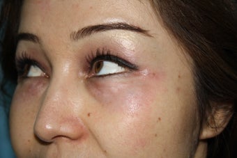 30 years female underwent Restylane filler for lower lid wrinkles