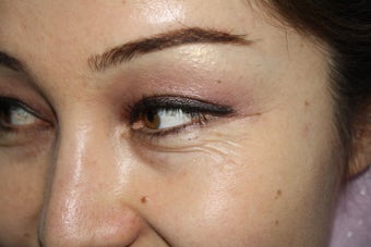 30 years female underwent Restylane filler for lower lid wrinkles