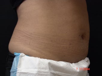 Coolsculpting