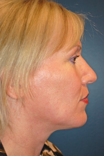 Nose Surgery