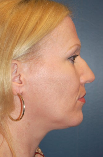 Nose Surgery
