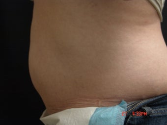 Coolsculpting