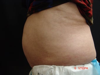 Coolsculpting