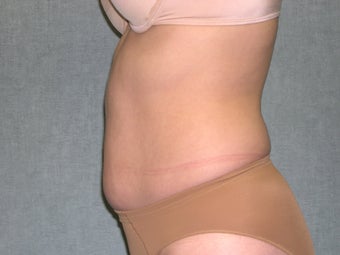 SmartLipo