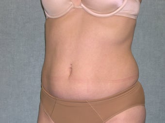 SmartLipo