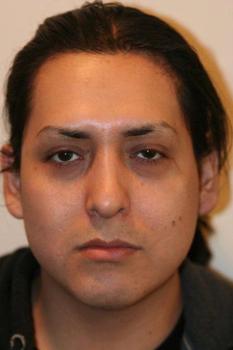 Submental liposuction and revision rhinoplasty