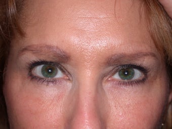 Botox