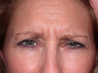 Botox